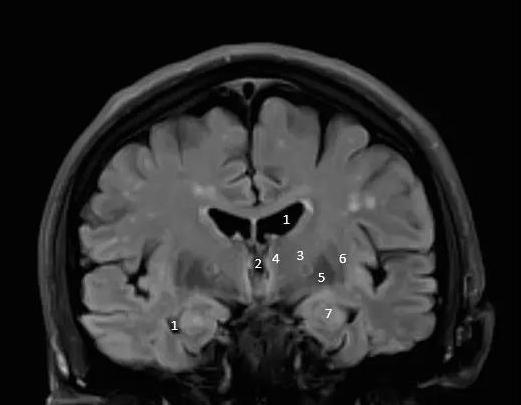 史上最全脑室解剖图谱快收藏了吧