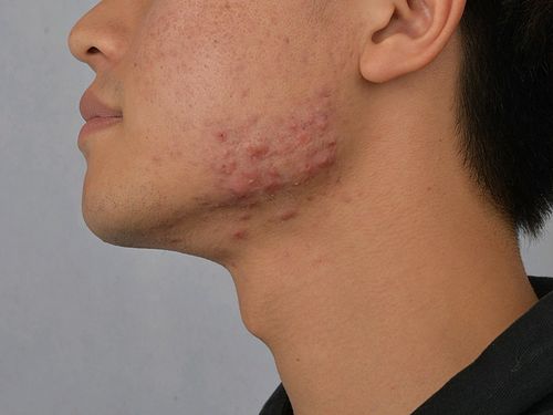 以前青春期长痘导致我两边下颌处各有一片的痘疤增生,_圈子-新氧美容