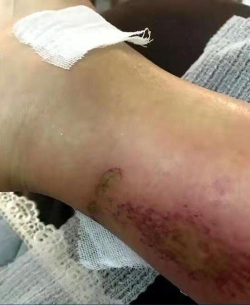 清远一女子散步被狗咬,伤口已发炎,狗主人拒绝赔偿