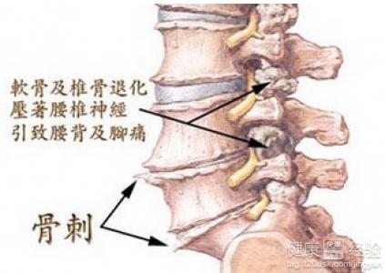 运动加饮食预防骨质增生