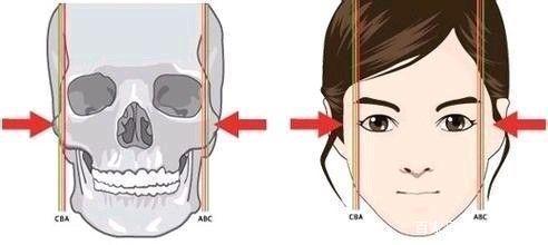 你知道颧骨内推术吗?