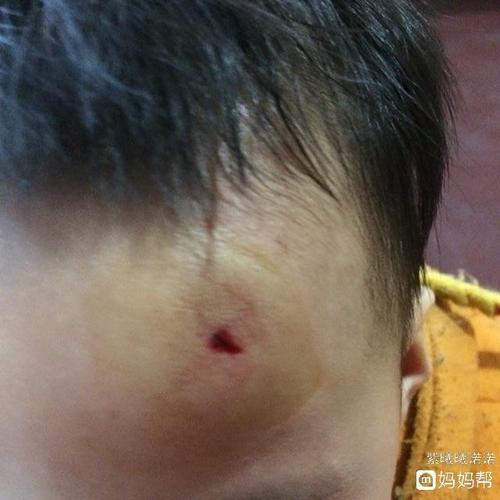 两岁的小孩不想走路没迈开腿头摔流血了