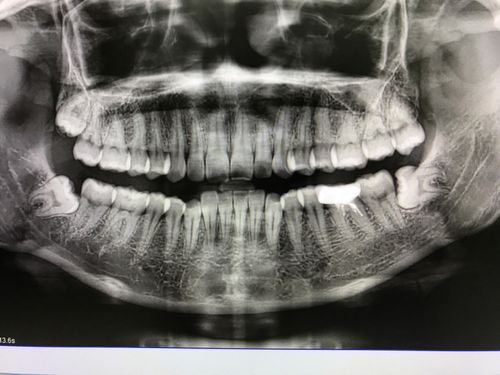 还很疼,我以为口腔骨质增生了,楼主是个对牙科充满恐惧的人,因为小