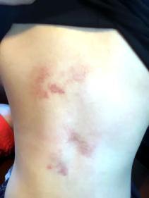 5岁男孩练轮滑称被教练"拧"后背多处淤青 教练:没有的事