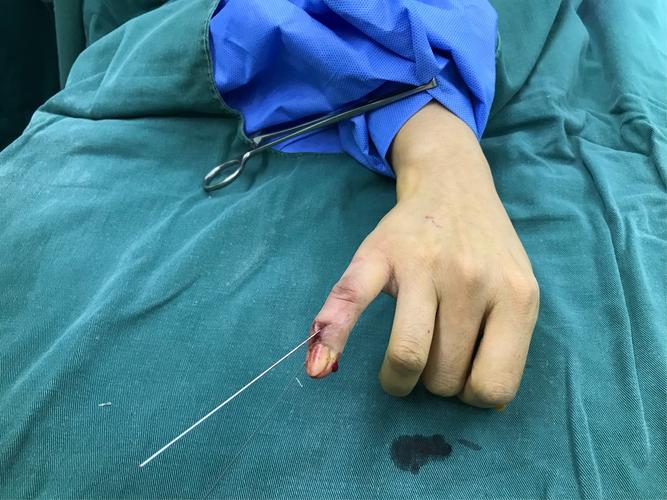 做到闭合复位 手术时间短 患者恢复快 避免切开 术后4-6周拔除克氏针