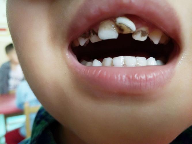 【通盛幼儿园】小小二班《蛀牙虫》