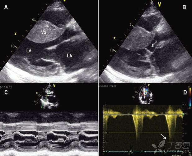 实际上这幅超声图像采集自一例安装有左心室辅助装置的心衰终末期患者