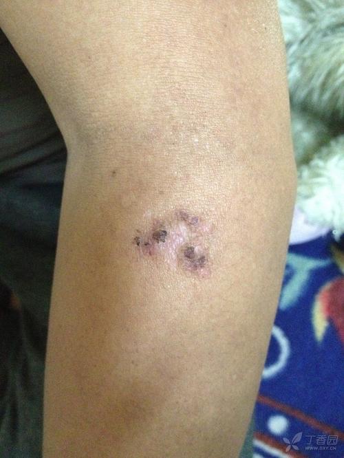 皮肤炭疽病例诊治分享