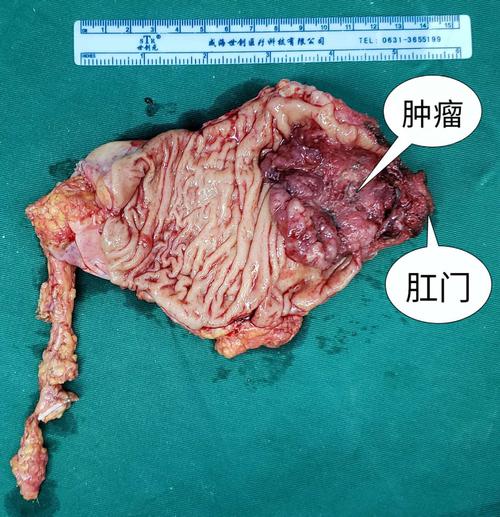 劈开肠壁,可见肿瘤近5cm,位于直肠下段肛管受累.