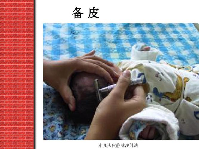 备皮 小儿头皮静脉注射法