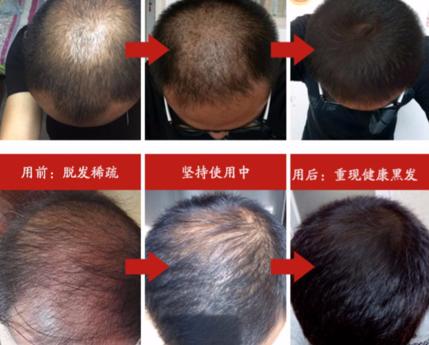 这样做让你减少脱发!还有5个生发