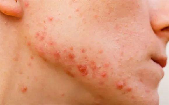 毛囊炎好发于脸上,脖子上,下巴颏(须疮),头上(头上流脓),臀部(屁股生