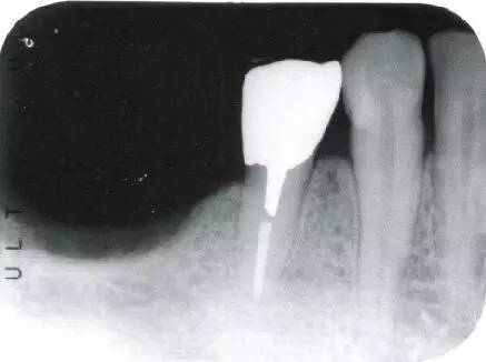 原则上我们只能预备主根管,因为根尖附近有无数根管侧枝.