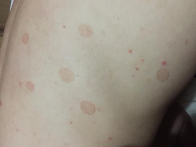 背上长出褐色斑块,这是皮肤病吗?严重吗?