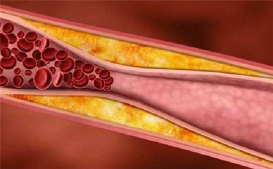 动脉粥样硬化为何要采取低频电生理进行循环治疗?