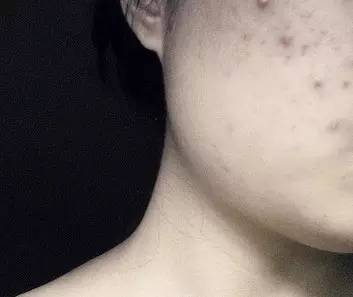 红色痘印?黑色痘印?轻松祛除有技巧!