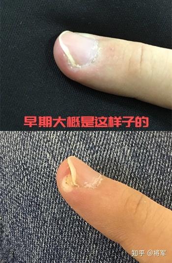 分享一下我治疗甲周疣的经历吧,我是2015年3月份出现的甲周疣,最初的