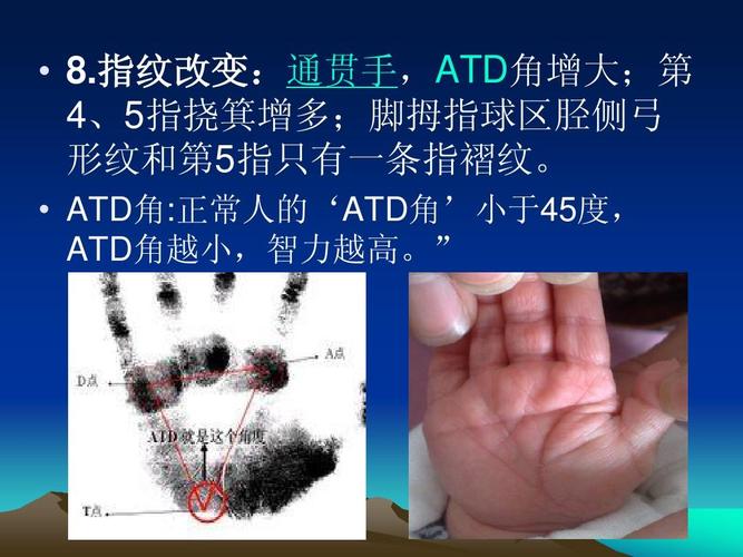 指纹改变:通贯手,atd角增大;第 指纹改变: 指纹改变 4,5指挠箕增多;脚