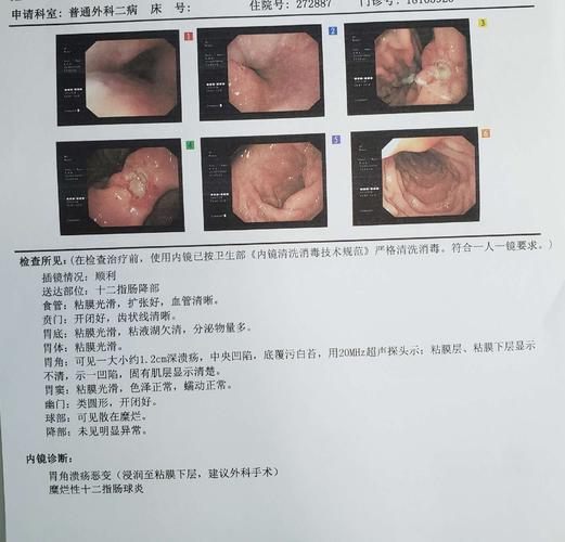 术前患者胃镜诊断:胃溃疡恶变.