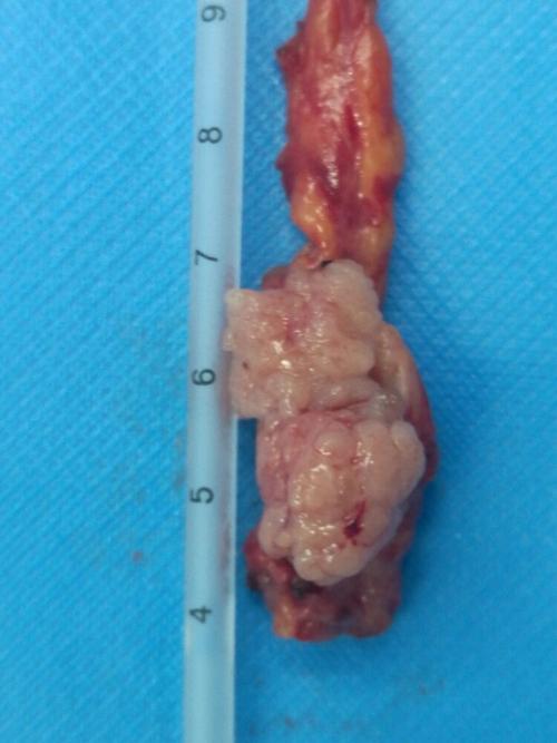 肿瘤菜花状,术前输尿管检查活检