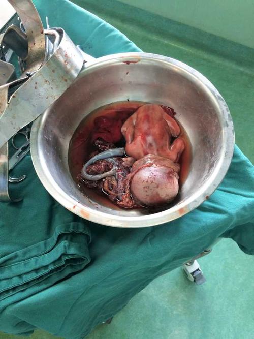 孕4~5月左右,肿瘤化疗术后,行子宫切除术取出一死胎