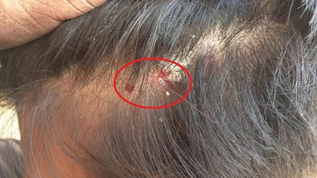 抓挠后会形成脓包,所以这种头皮的人一定要及时洗头,时刻保持头发的