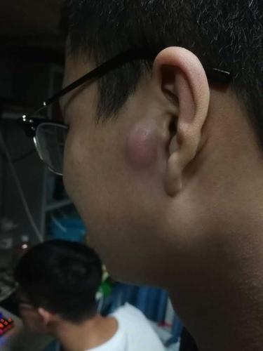 耳朵附近长了个包,该怎么办?