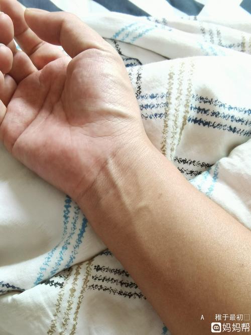 你们孕晚期有没有像我一样手腕血管又凸又