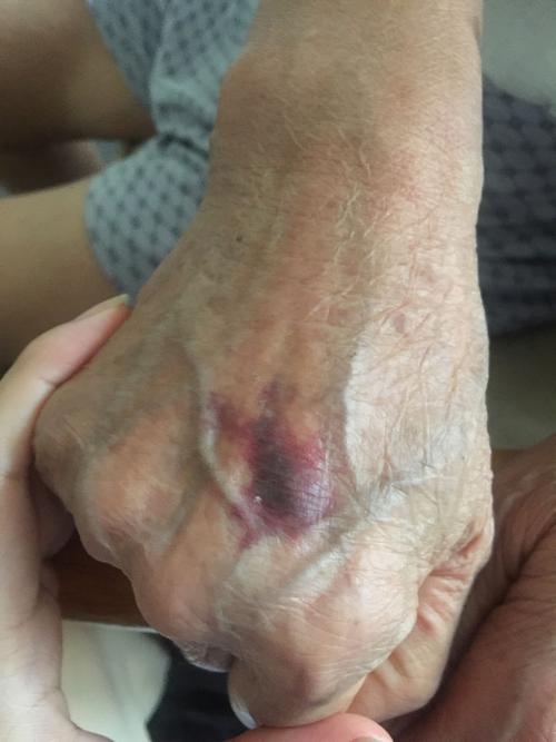 老人家手背突然发现淤血是怎么回事啊