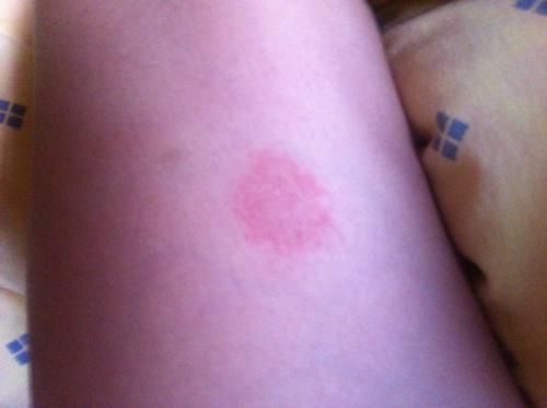 大腿上莫名其妙的出现了一块儿红斑,不疼不痒,好长一段时间了也不见下