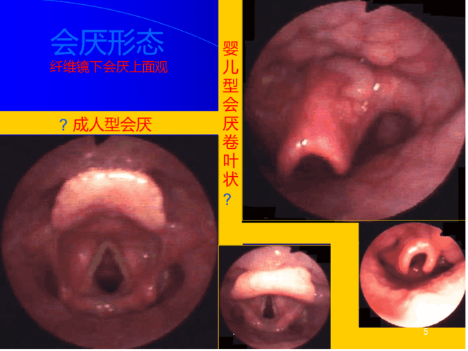 喉解剖急性会厌炎急慢性喉炎ppt课件