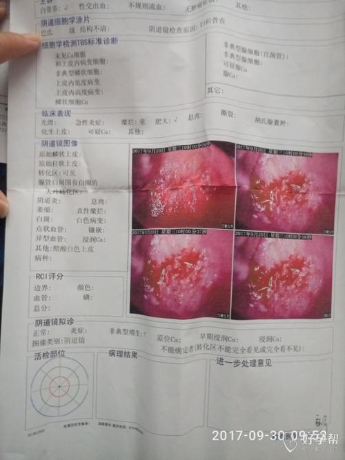 非典型鳞状上皮细胞一定要活检吗