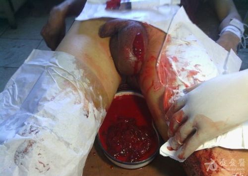 武某某 男 31岁 自切睾丸一例