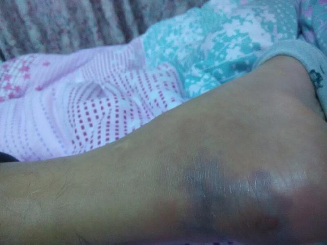 脚后跟长的冻疮,因为没买冻疮膏,所以变成现在这个样子,脚踝也肿了