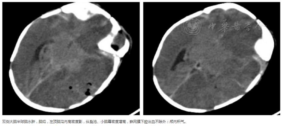 新生儿化脓性脑膜炎合并气脑患儿(7日龄)头颅ct