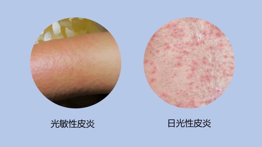 夏季警惕这四种皮肤病!