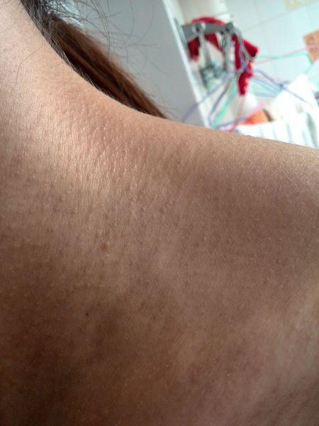 脖子上面长得这些小点点,一直都这样也不消下去,是鸡皮肤吗