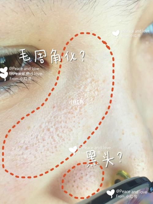 毛周角化@红卡薯