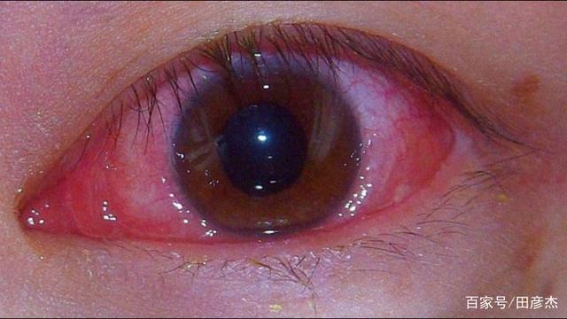 眼睛红了以为只是疲劳惹的祸未必5种疾病都会眼睛红