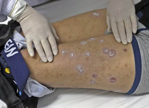 艾滋病皮疹是怎样的 得了艾滋病有什么特点