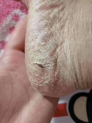 这是鳞屑角化型足癣