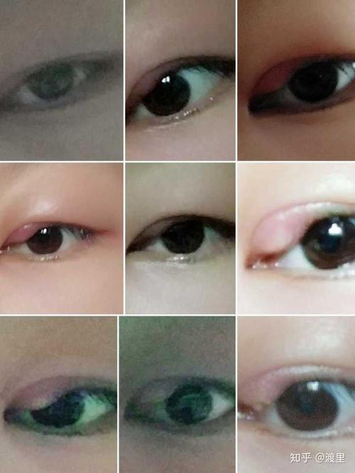 有没有得过外麦粒肿的朋友,怎么个痊愈过程.