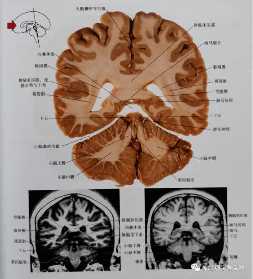 通过松果体,丘脑枕的尾部,上丘,脑干被盖,小脑中脚平面的冠状位