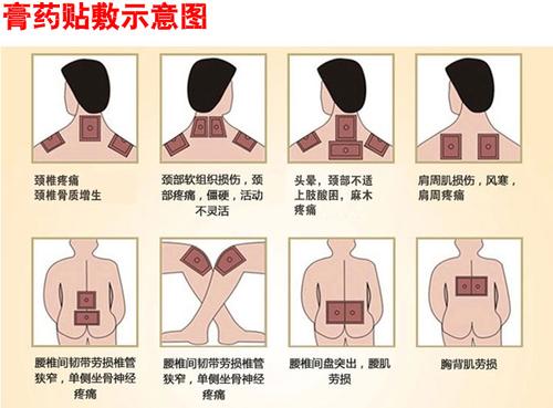 膏药贴敷示意图.png