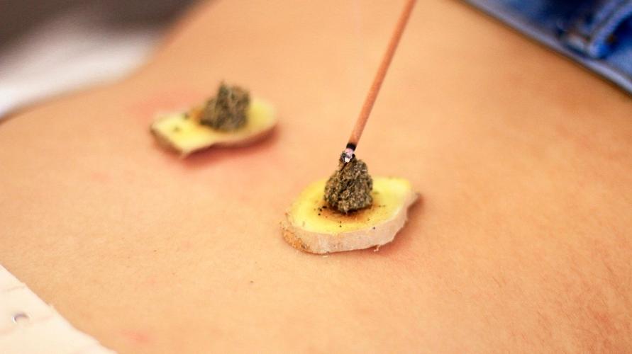 隔姜灸又分为隔姜片灸和隔姜蓉灸.