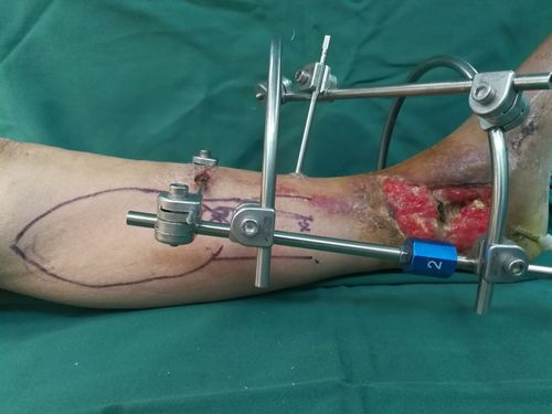 胫后动脉穿支皮瓣设计.