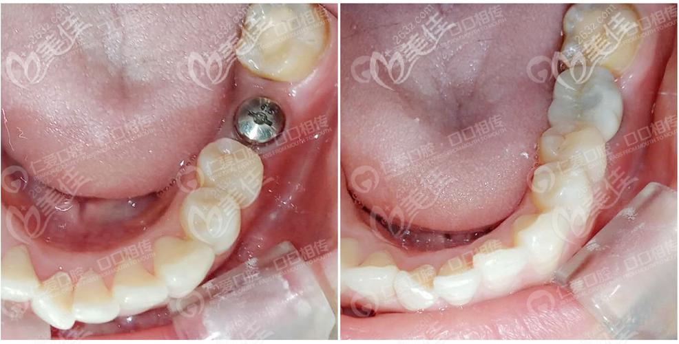 不要说武汉仁爱口腔价格坑人了看看微创种植牙真实案例你就明白了