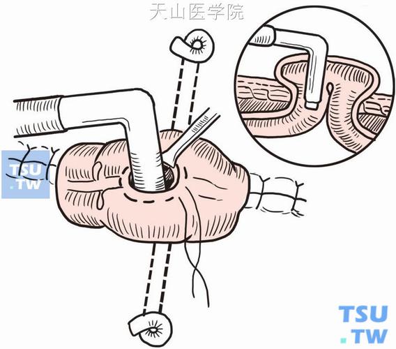 结肠襻式造口术