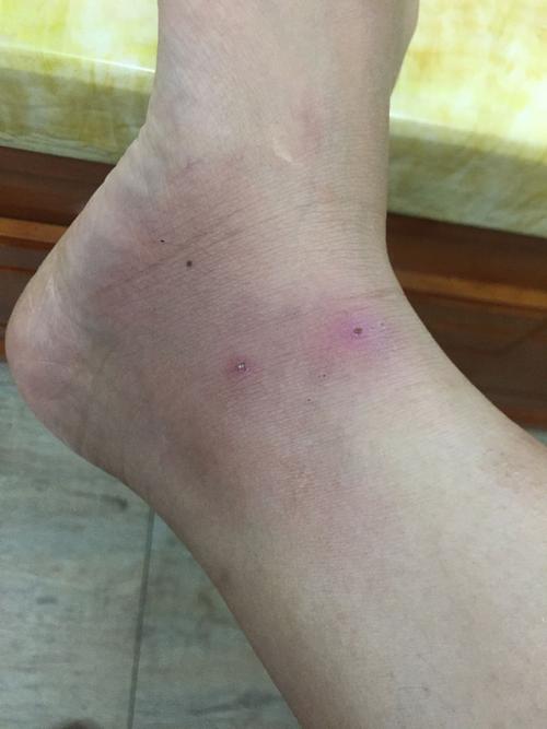 这是被什么虫咬到的伤口,很痒很痛,需要如何治疗