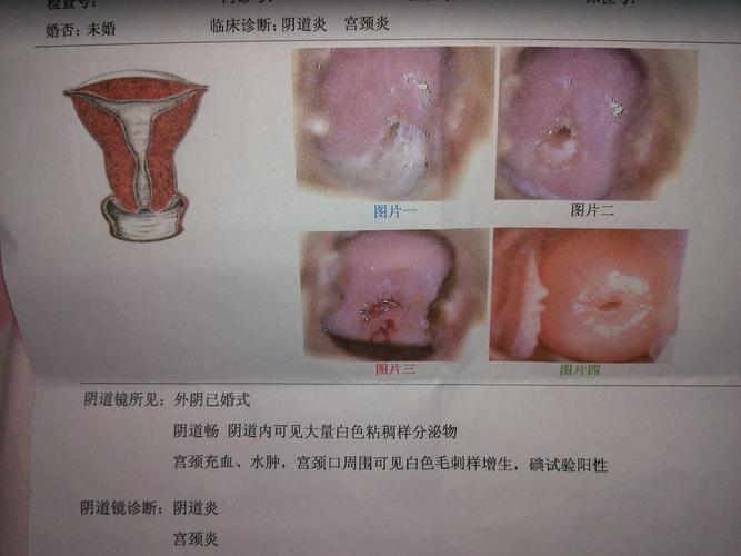 短裤上有白色分泌物/,女性尿道口肉芽照片
